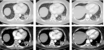 胸部增强ct：左肺下叶基底段软组织密度灶，周围可见磨玻璃密度灶及索条