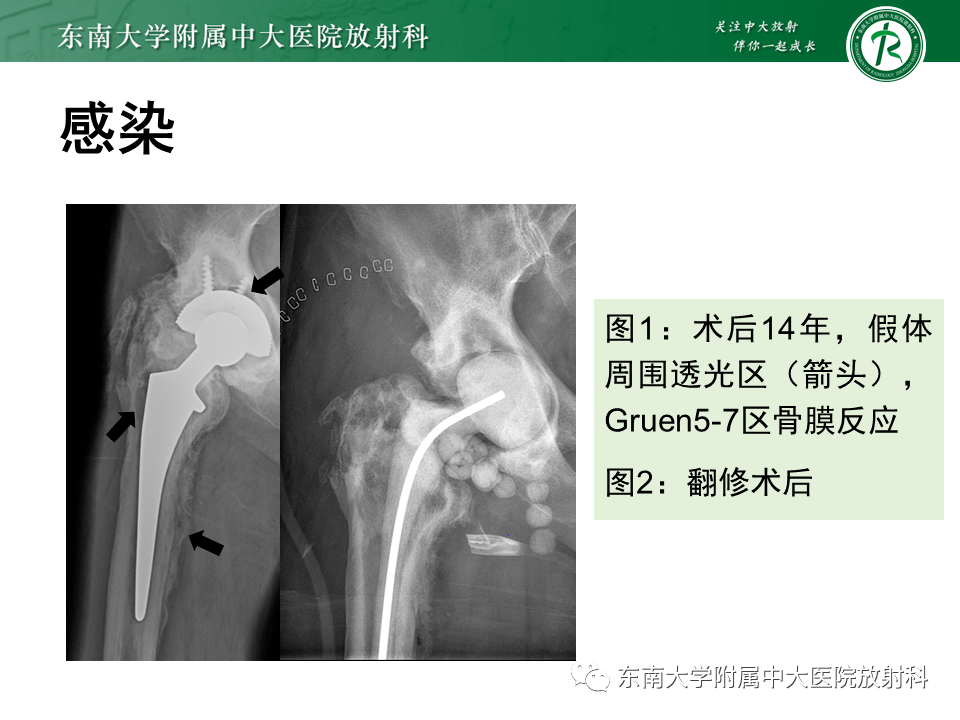 編輯/校對 查俊豪病史男,64歲主訴:右髖關節置換術後14年,右腹股溝