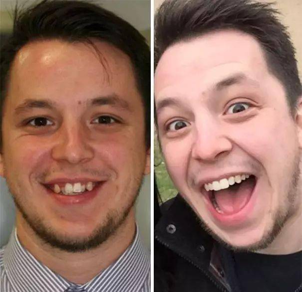 牙齿_钢牙_问题