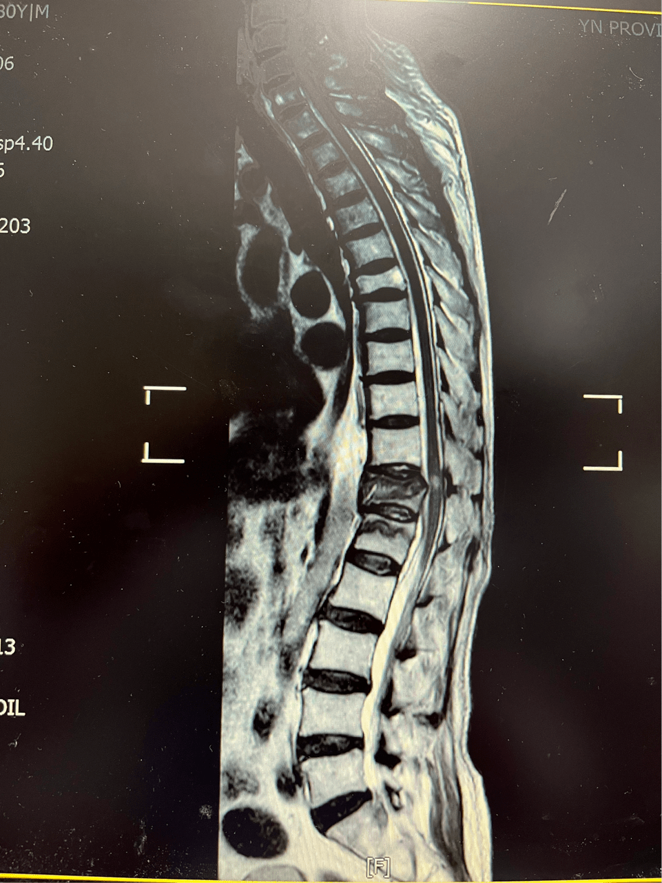下,杨爷爷于1月12日顺利手术,由叶医生为其进行了t11-l2椎管扩大减压