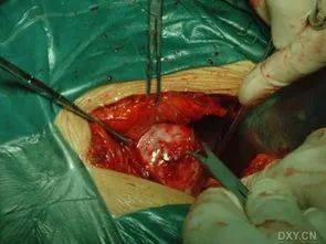 一个女人没了子宫会怎样你绝对想象不到
