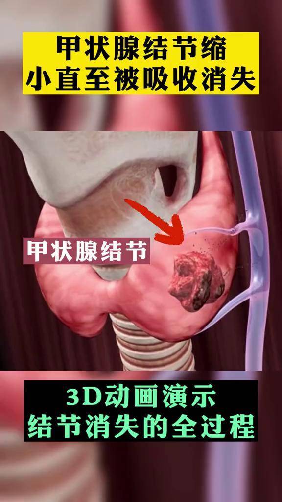 甲狀腺結節是如何消失的甲狀腺結節醫學科普中醫