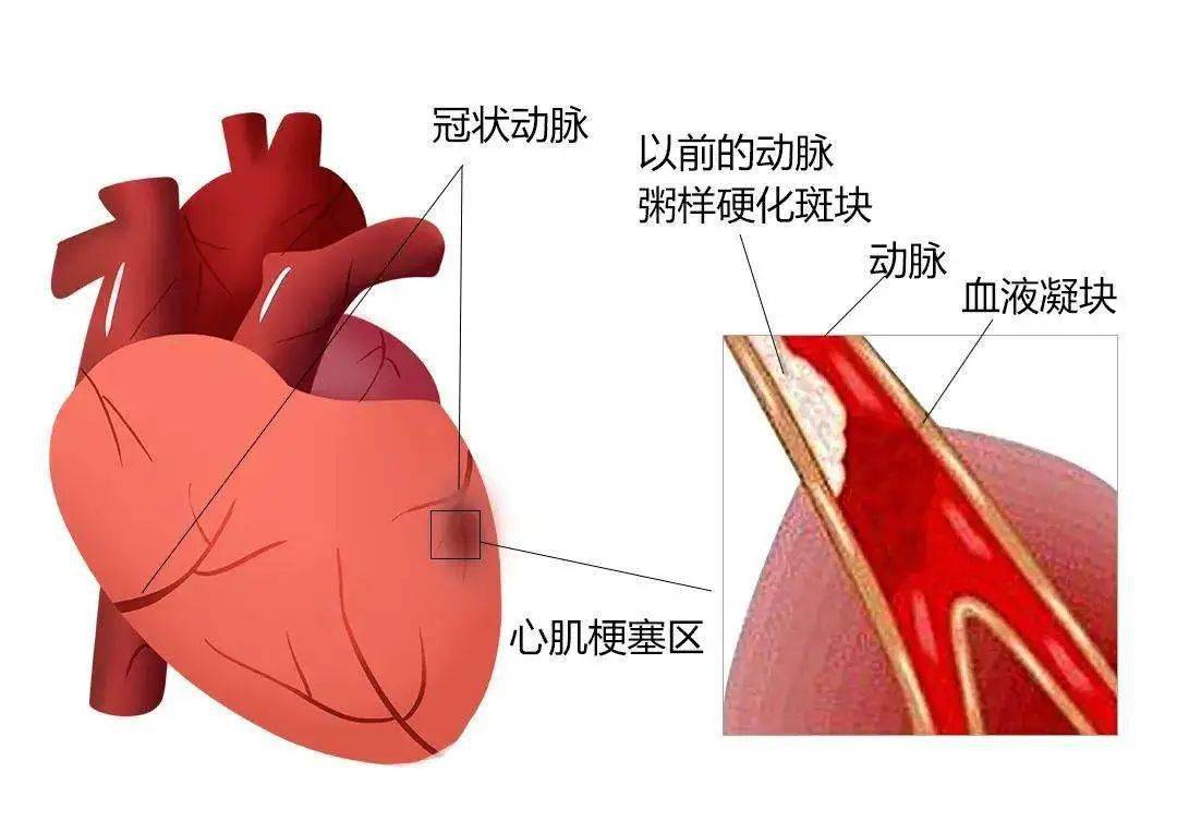 患者心臟左主幹遠端90%狹窄,前降支近端85%左右狹窄,迴旋支開口90%