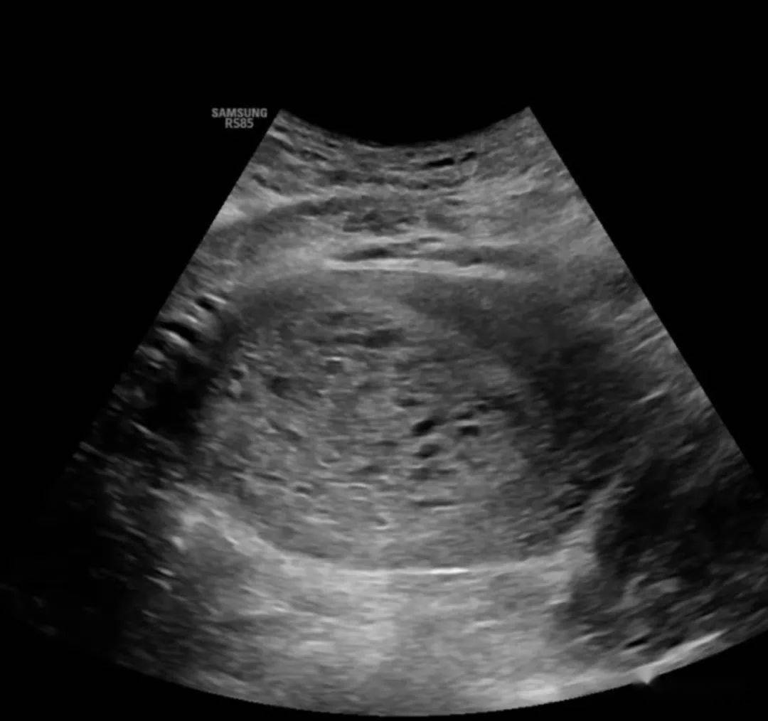 怀孕一个月葡萄胎照片图片
