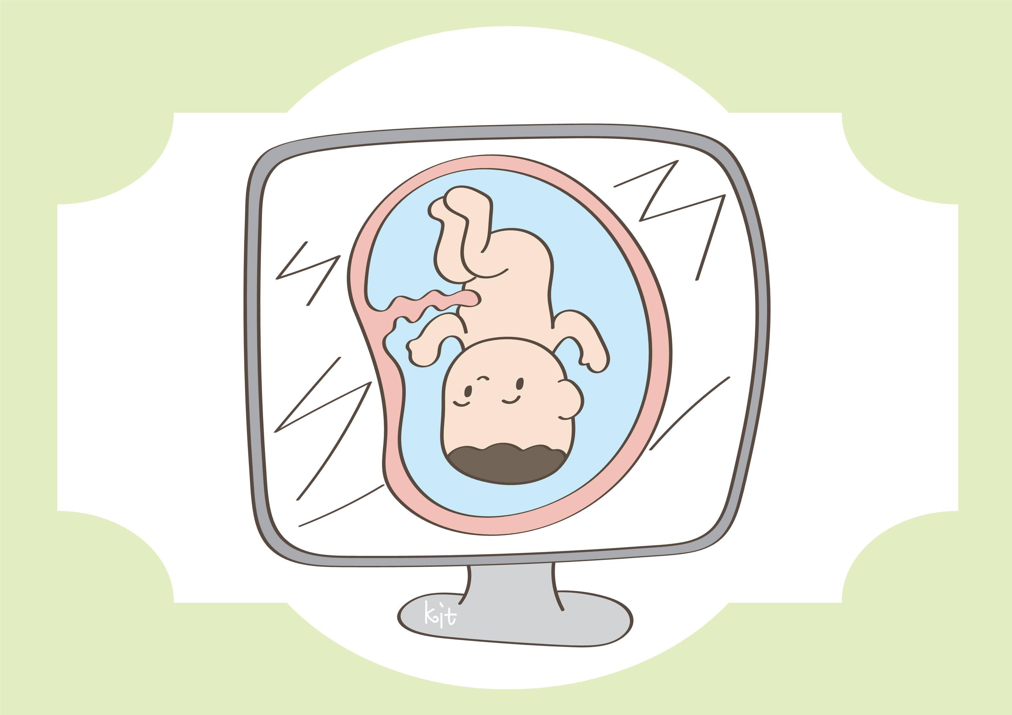 孕妇如果出现这些信号胎儿可能脐带绕颈请提前做好预防