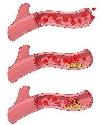 "溶栓高手"找到,不是木耳,平时多吃点,或让血栓"知难而退"_血管_疾病