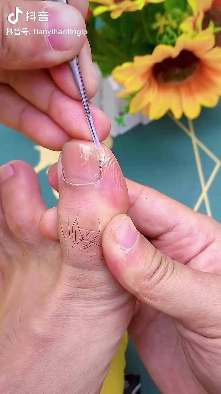 竹签钉脚趾缝图片