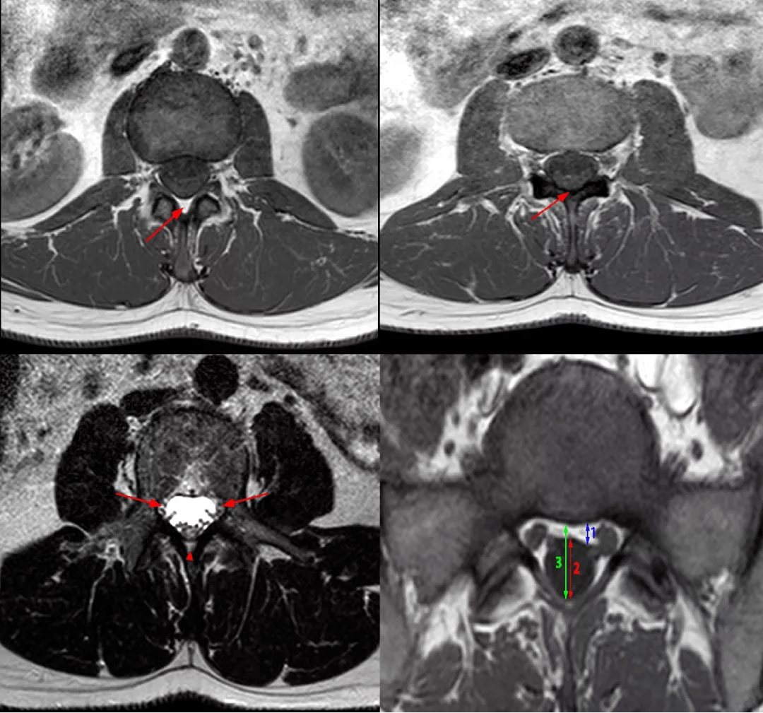 常见易忽略的疾病椎管内硬膜外脂肪增多症