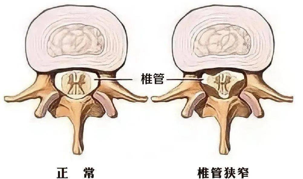 六類腰椎盤突出患者必須手術腰椎患者你在其中嗎