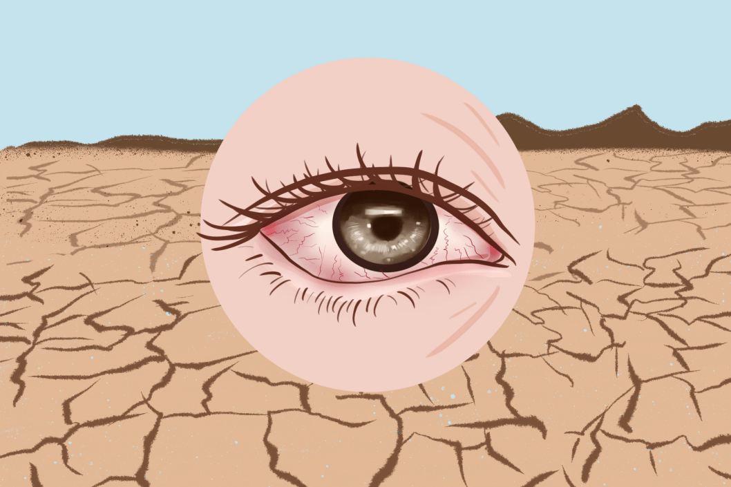 如何避免干眼症保护眼健康