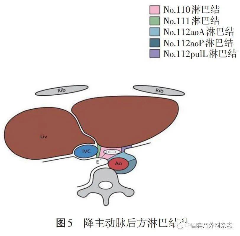 論著經食管裂孔下縱隔淋巴結清掃在siewertⅡ型食管胃結合部腺癌根治