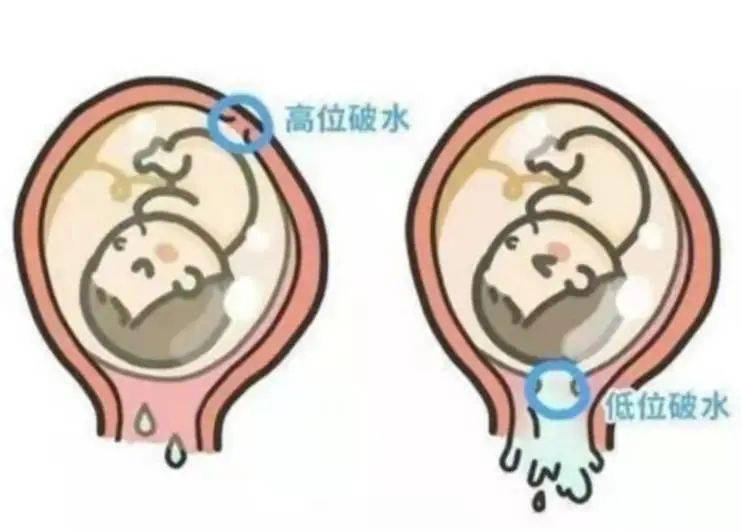 胎膜早破分泌物图片
