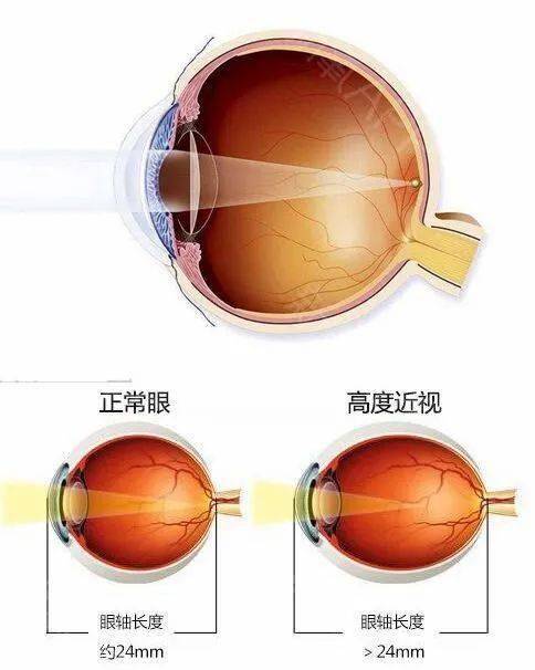 近视眼视网膜成像图图片