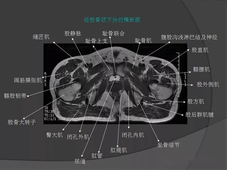 骨盆肌肉解剖mri標識