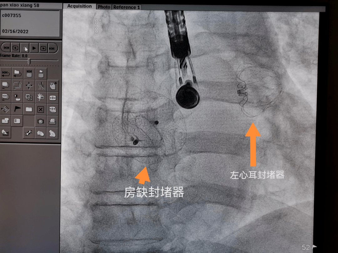 房間隔缺損,動脈導管未閉,冠狀動脈-肺動脈瘻,左心耳封堵等心臟介入