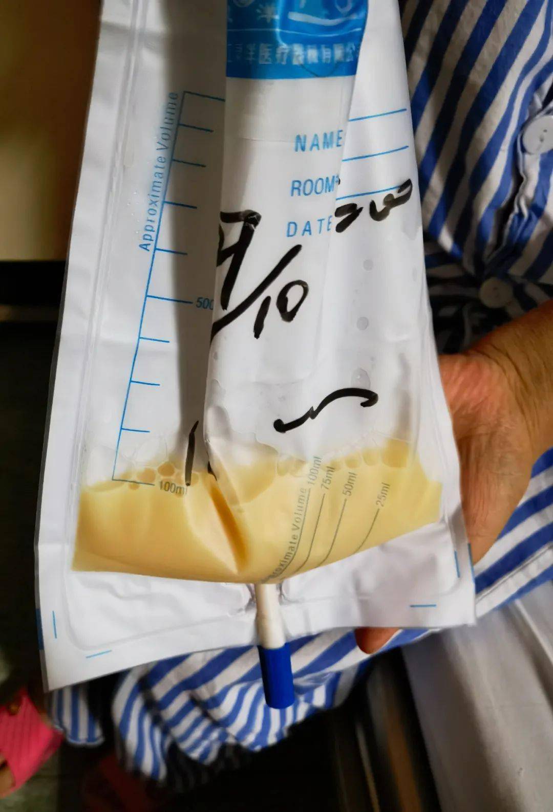 27岁小伙每天产"奶"2斤,竟是这里漏了→_阿辉_淋巴管_腹腔