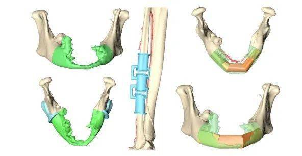 虚拟手术设计在腓骨组织瓣下颌骨重建中的应用fomm杂志文章精选