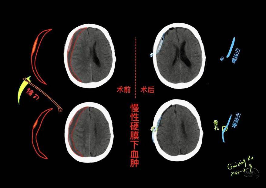 徐桂興|顱腦解剖影像手繪_蝶骨_定位_博士