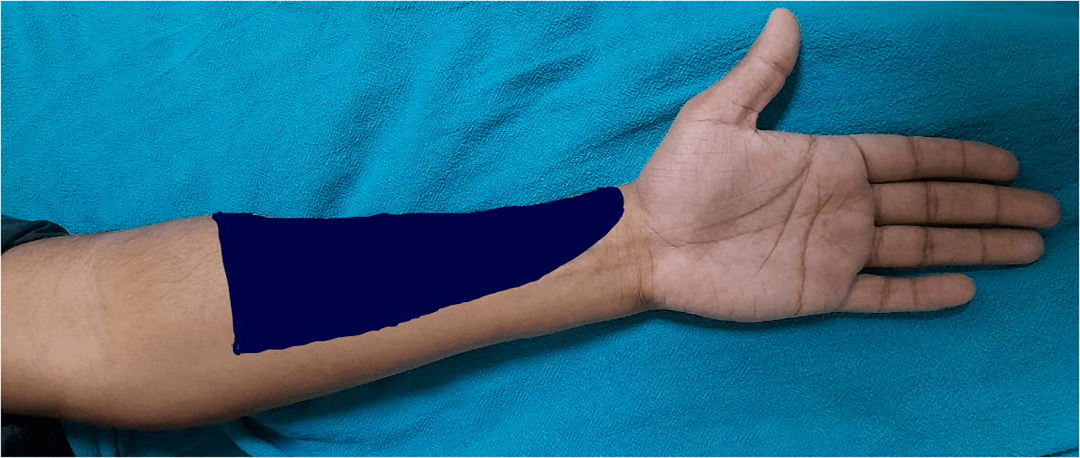 桡动脉穿刺置管疼痛管理新技术前臂外侧皮神经阻滞