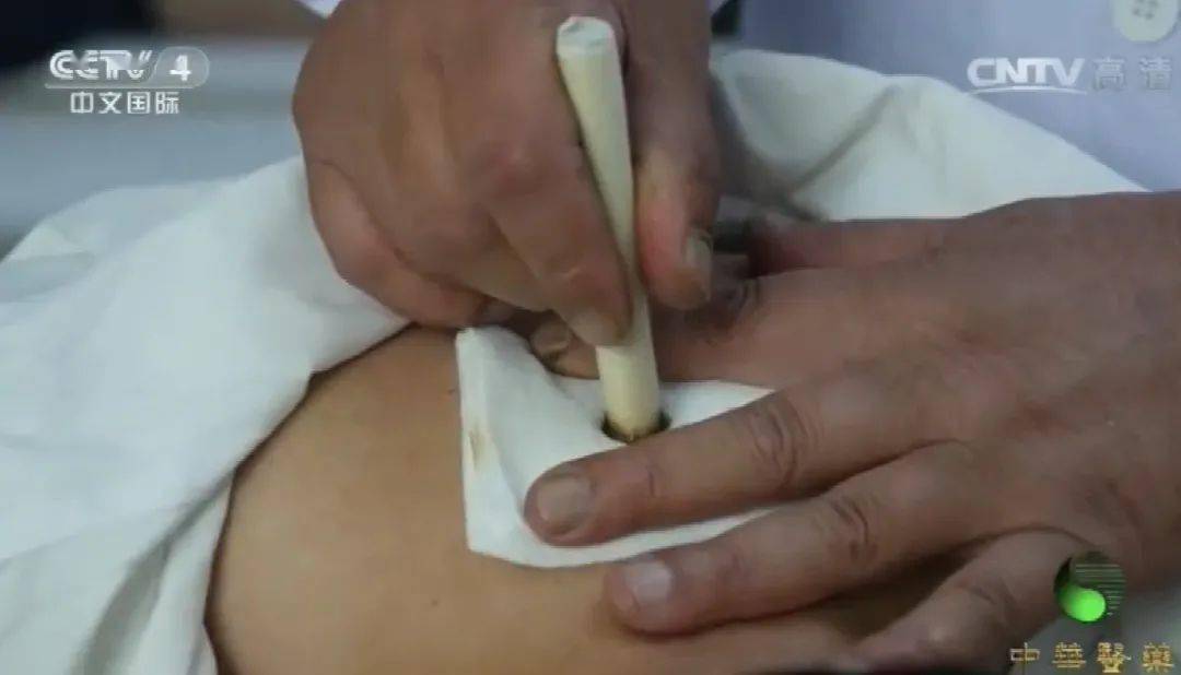 疝内容用手法还纳,如与针灸作用相比,则后者远较前者为优越,间隔时间