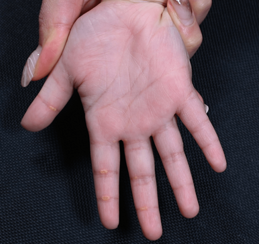 2岁孩子手掌不断长出黄疙瘩原来是患上了罕见病