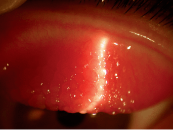 春季角结膜炎的结膜乳头非特异性结膜炎:导致严重并发症非特异性结膜
