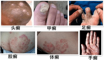 湿疹与真菌感染对照图图片