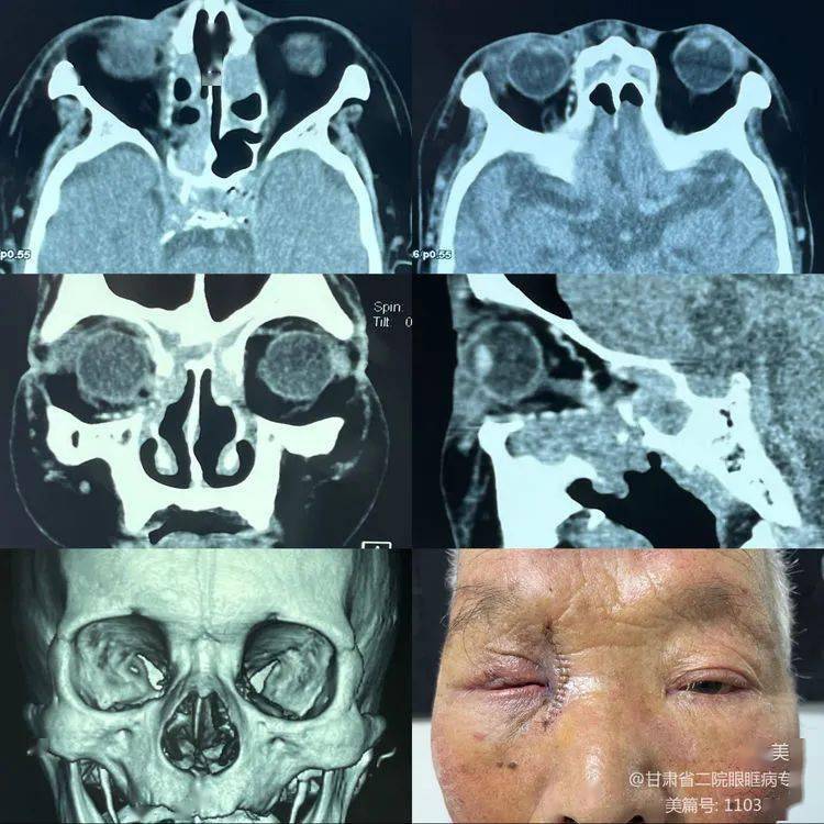 病例分享高龄患者的眼眶肿物仍需要手术