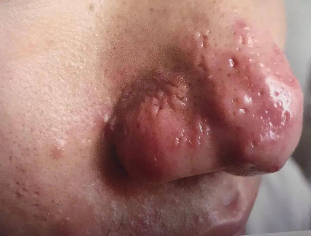 鼻赘型,多见于鼻部,在红斑或毛细血管扩张基础上皮脂腺肥大增生伴纤维