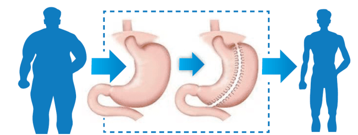 胃旁路减肥手术后的饮食(胃旁路手术后会一直瘦下去吗?)