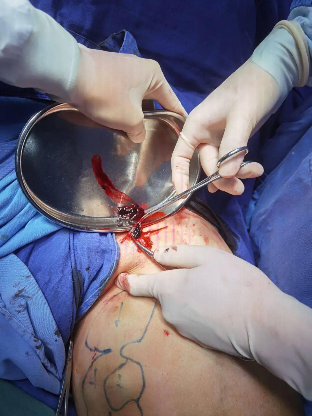 静脉滤器植入术过程图图片