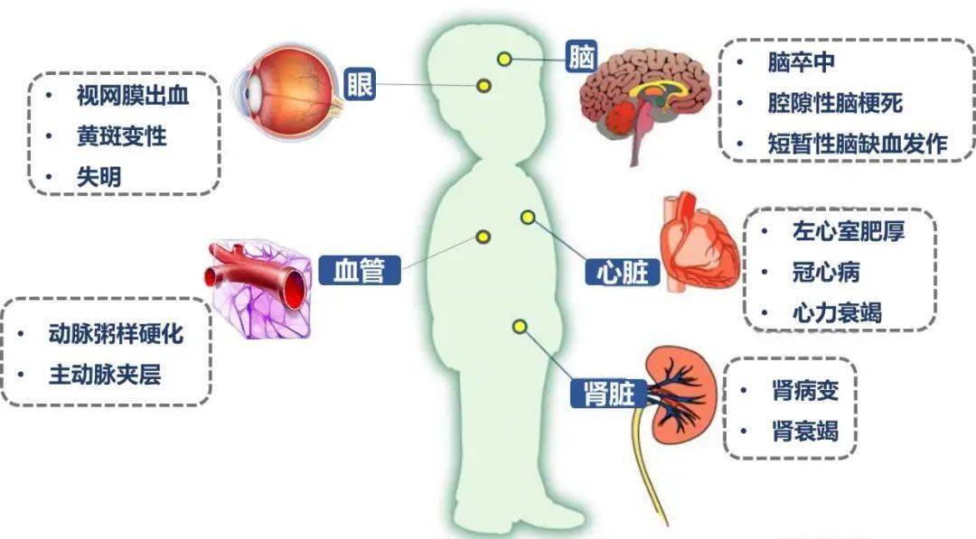 得了高血压还会瞎?!了解一下什么是高血压视网膜病变_眼底_患者_心脑血管