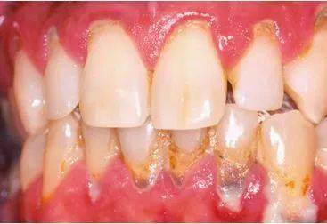 2,妊娠性牙周炎:牙龈红肿,出血,咀嚼无力,牙槽骨吸收,牙齿松动,主要是