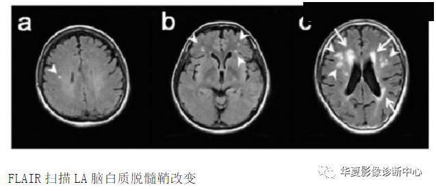 区内|MR脑白质区内斑点影，腔梗、脱髓鞘、缺血灶，应如何书写影像报告