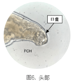 合并|一例分析 | 类风湿关节炎患者合并「钩虫感染」