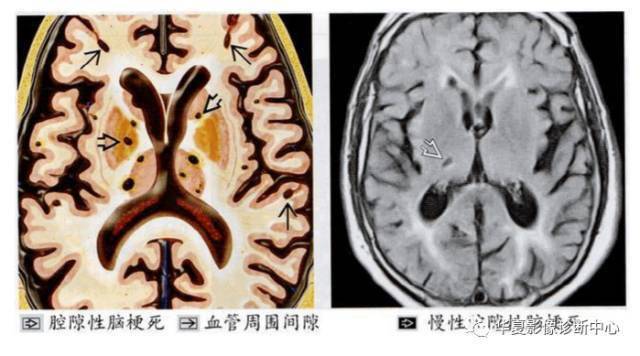 区内|MR脑白质区内斑点影，腔梗、脱髓鞘、缺血灶，应如何书写影像报告