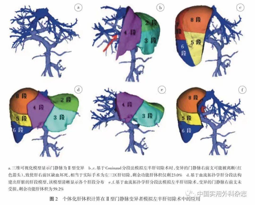 3 三維可視化血流拓撲學個體化肝臟分段在解剖性肝切除術應用 應用