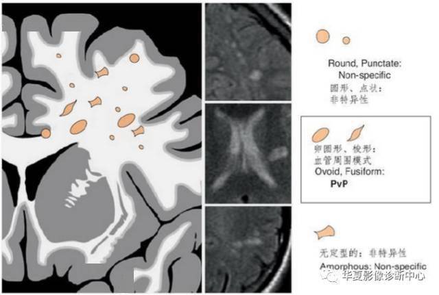 区内|MR脑白质区内斑点影，腔梗、脱髓鞘、缺血灶，应如何书写影像报告