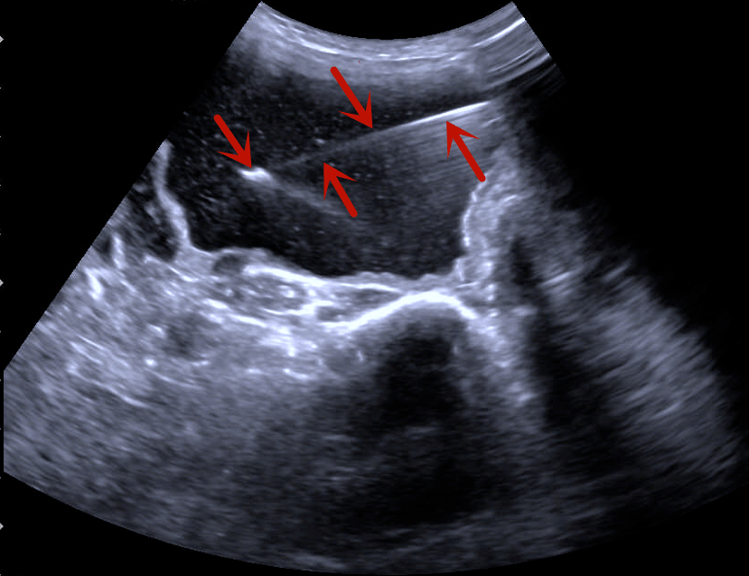 在超声的实时监控下,将一根穿刺针置入甲状腺囊肿内并抽尽囊液,再通过