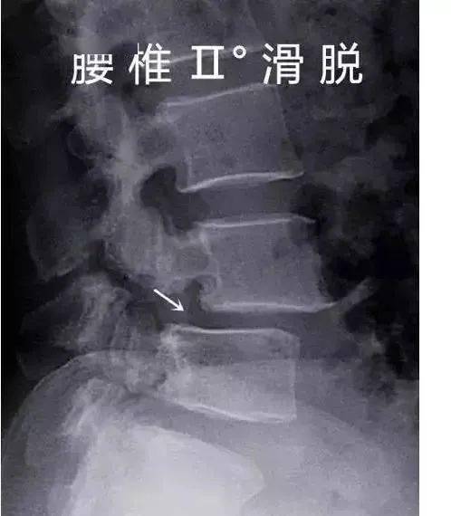 腰椎滑脱程度的等级清晰图解