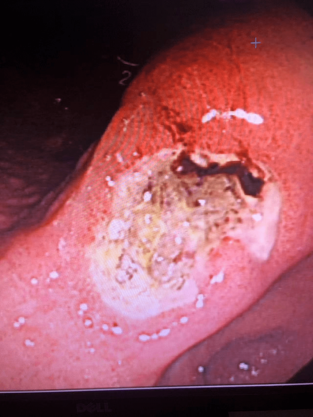胃溃疡胃镜报告单图片