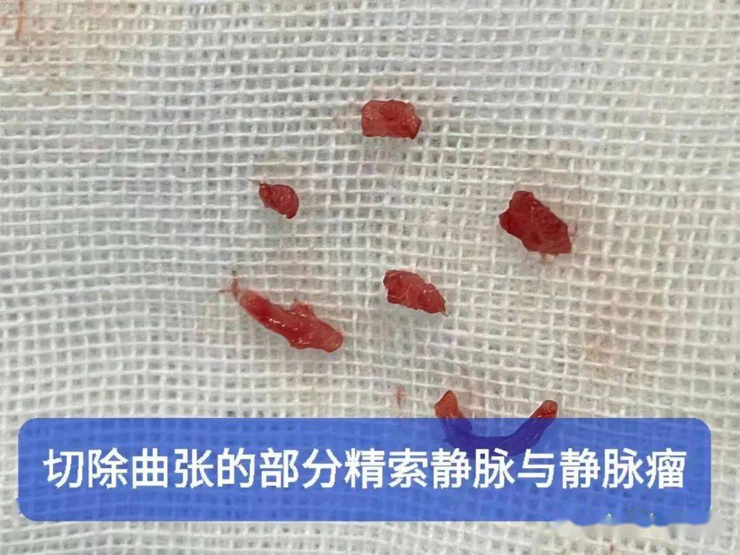广西县级首例合浦人民医院自主实施显微镜下精索静脉曲张低位结扎术