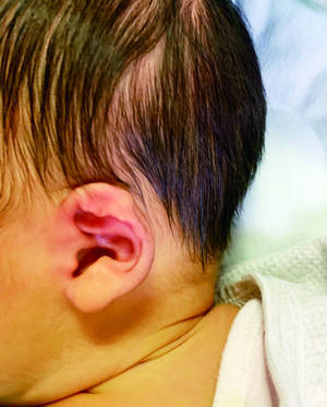 新生儿耳廓畸形勿忽视6周内是最佳矫正时机