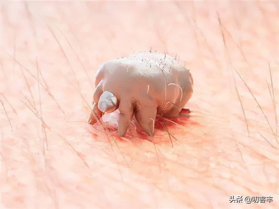 寄生虫感染引起的皮肤疾病