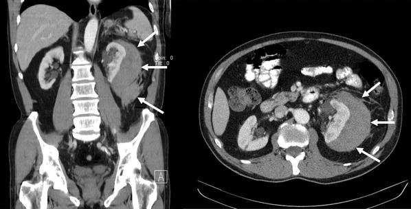 治疗|ESWL肾血肿的发生率和危险因素