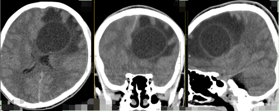 莫慌,良性腦瘤預後良好_手術_腫瘤_穆林森