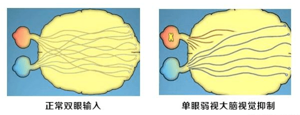 多见于非交替性斜视04先天性白内障,上睑下垂形觉剥夺03双眼度数相差