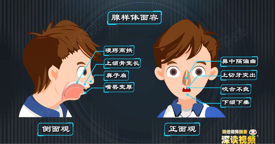 4歲寶寶打呼嚕不是事還會影響發育變醜腺樣體肥大究竟是啥