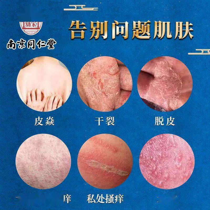 皮炎湿疹越挠越痒用它喷一喷3s止痒去疹除根不复发