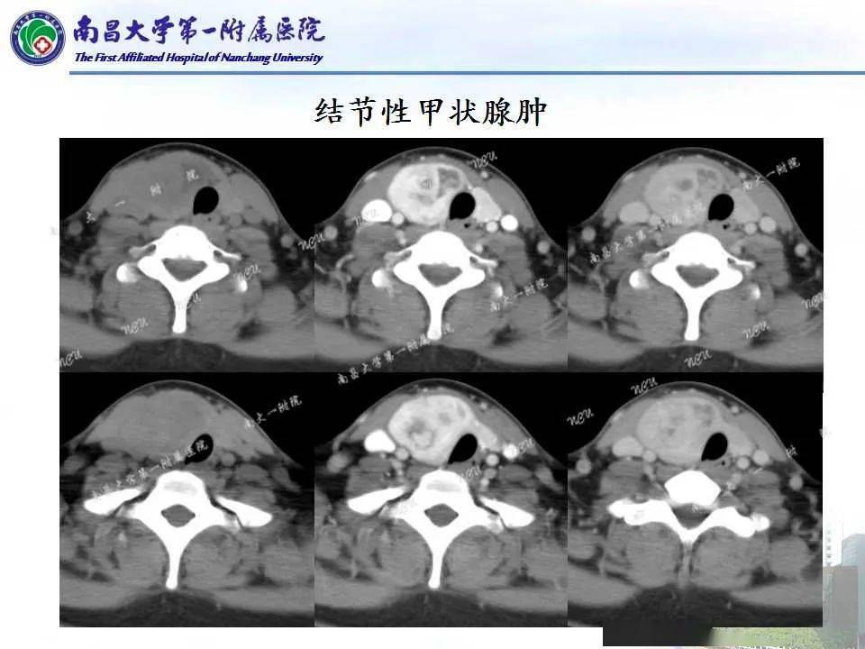 全面解析常見甲狀腺結節的ct鑑別診斷